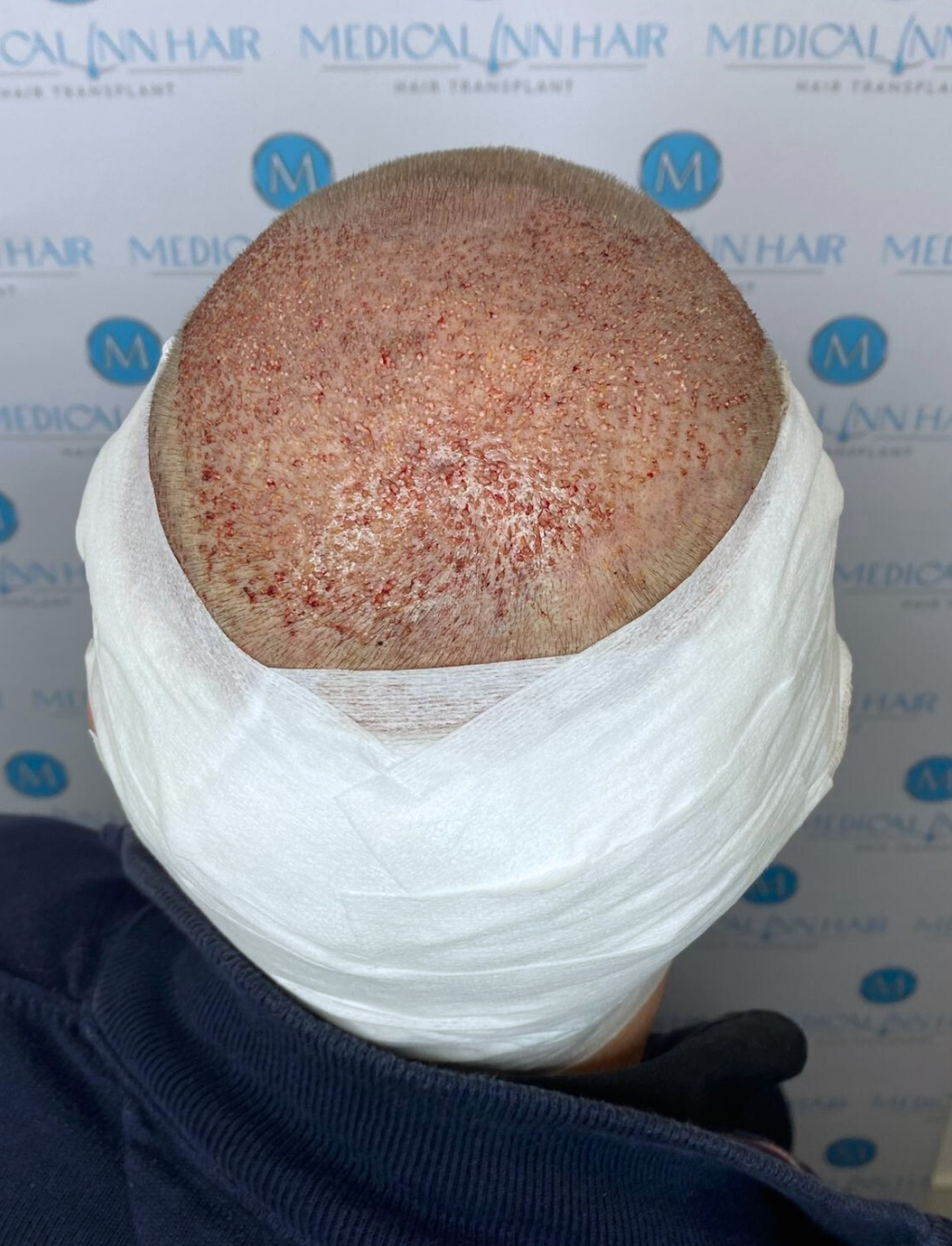 Zeitplan für Aktivitäten nach der Haartransplantation